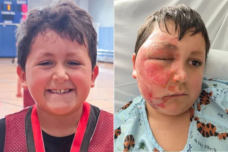 9-Year-Old Hospitalized With Severe Facial Burns After Attempting a&hellip;